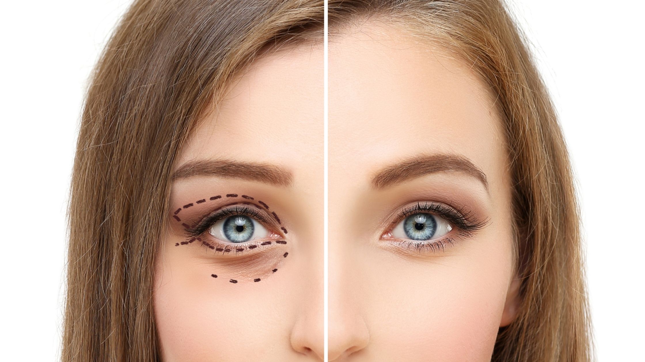 Blefaroplastia