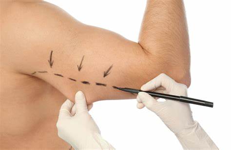 Braquioplastia