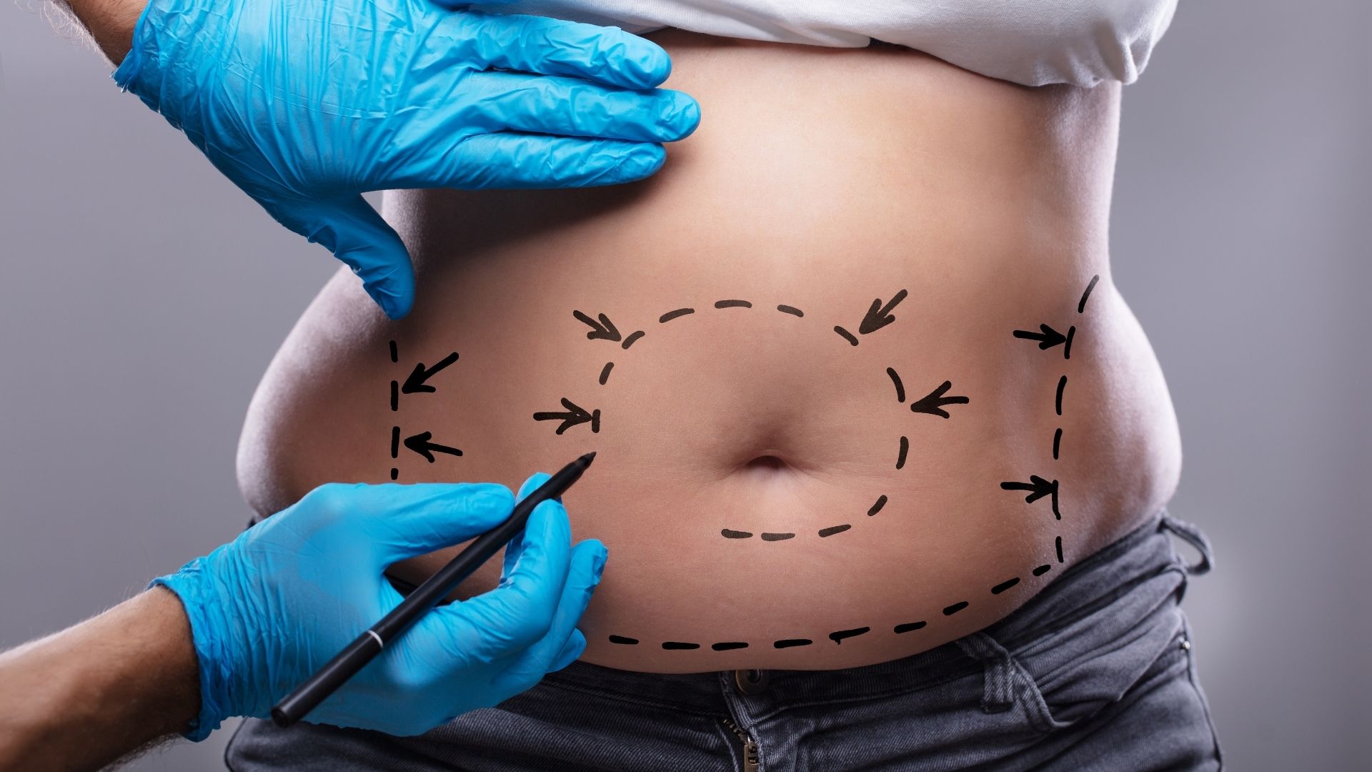 Liposuccion