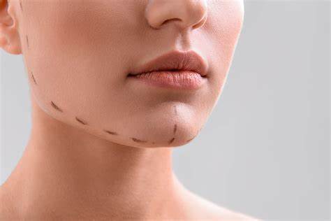 mentoplastia