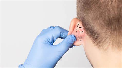 Otoplastia