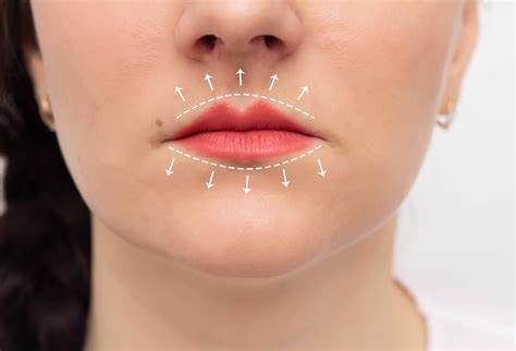 queiloplastia