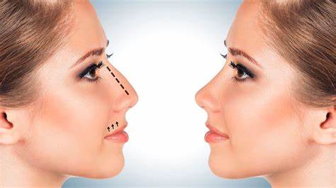 Rinoplastia